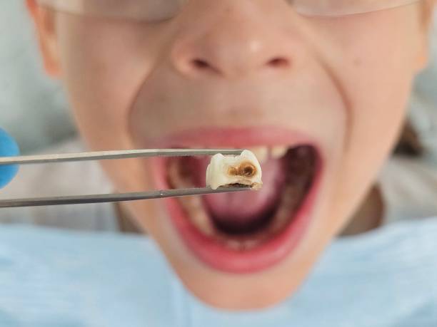Best Emergency Tooth Extraction  in Long Branch, VA